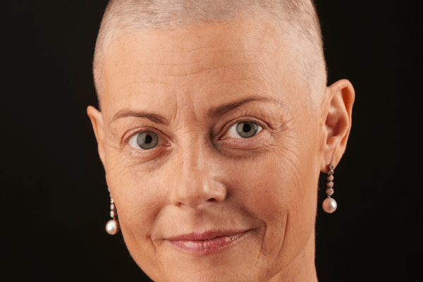 woman with baldness from chemotehrapy